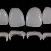 Gidedental Prosthetic Rehabilitation on Natural Teeth – Predictable, Esthetic and Systematic Steps 2020 (Videos)