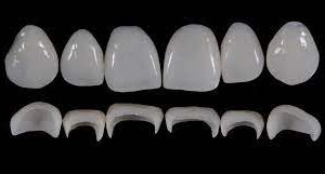 Gidedental Prosthetic Rehabilitation on Natural Teeth – Predictable, Esthetic and Systematic Steps 2020 (Videos)